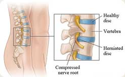 herniated_disc